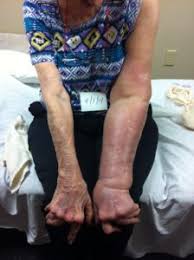 A breast cancer patient with lymphedema